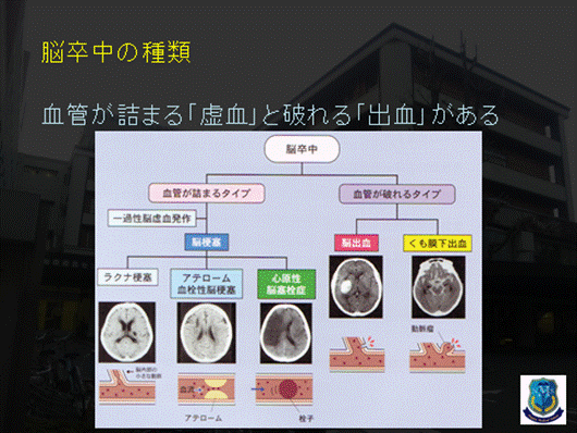 脳卒中の種類